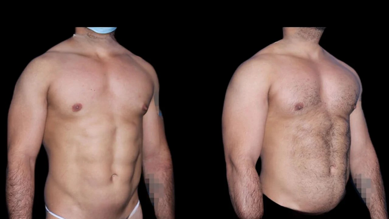 Male chest implant before and after results in uae