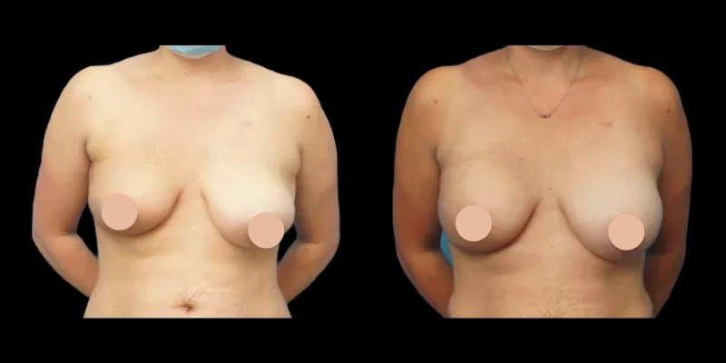 Abreast Reconstruction Before and After Results in Dubai