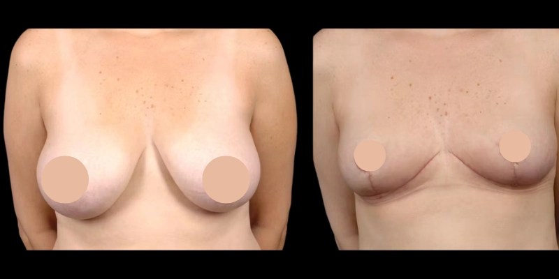 Breast reduction before and after pictures in dubai