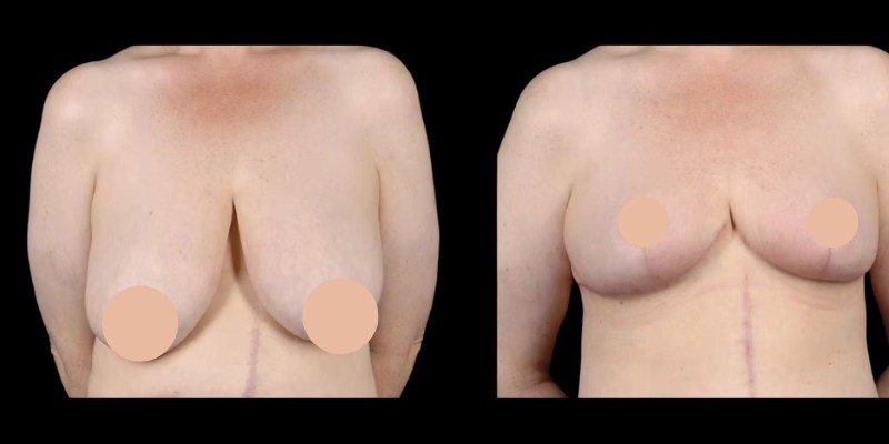 Breast Reduction before and after pictures in abu dhabi