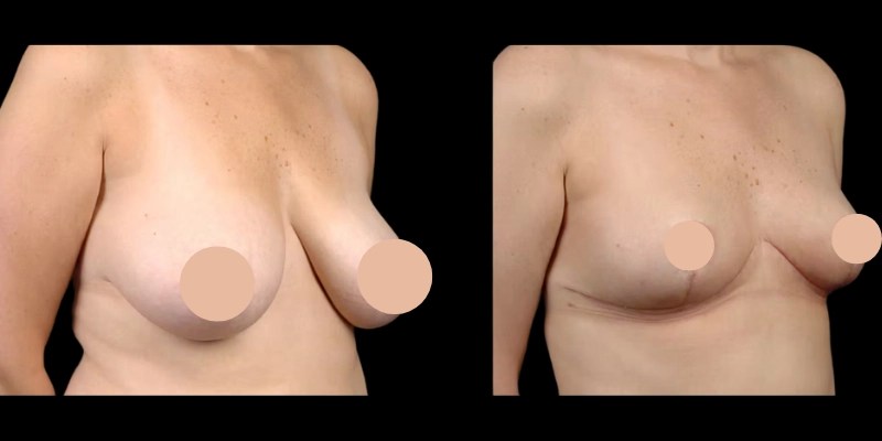 Breast liposuction