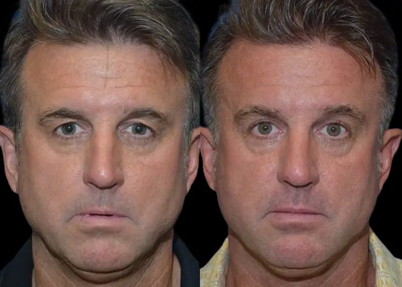 Male brow lift