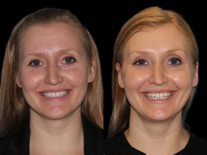 face wrinkle fat transfer in UAE