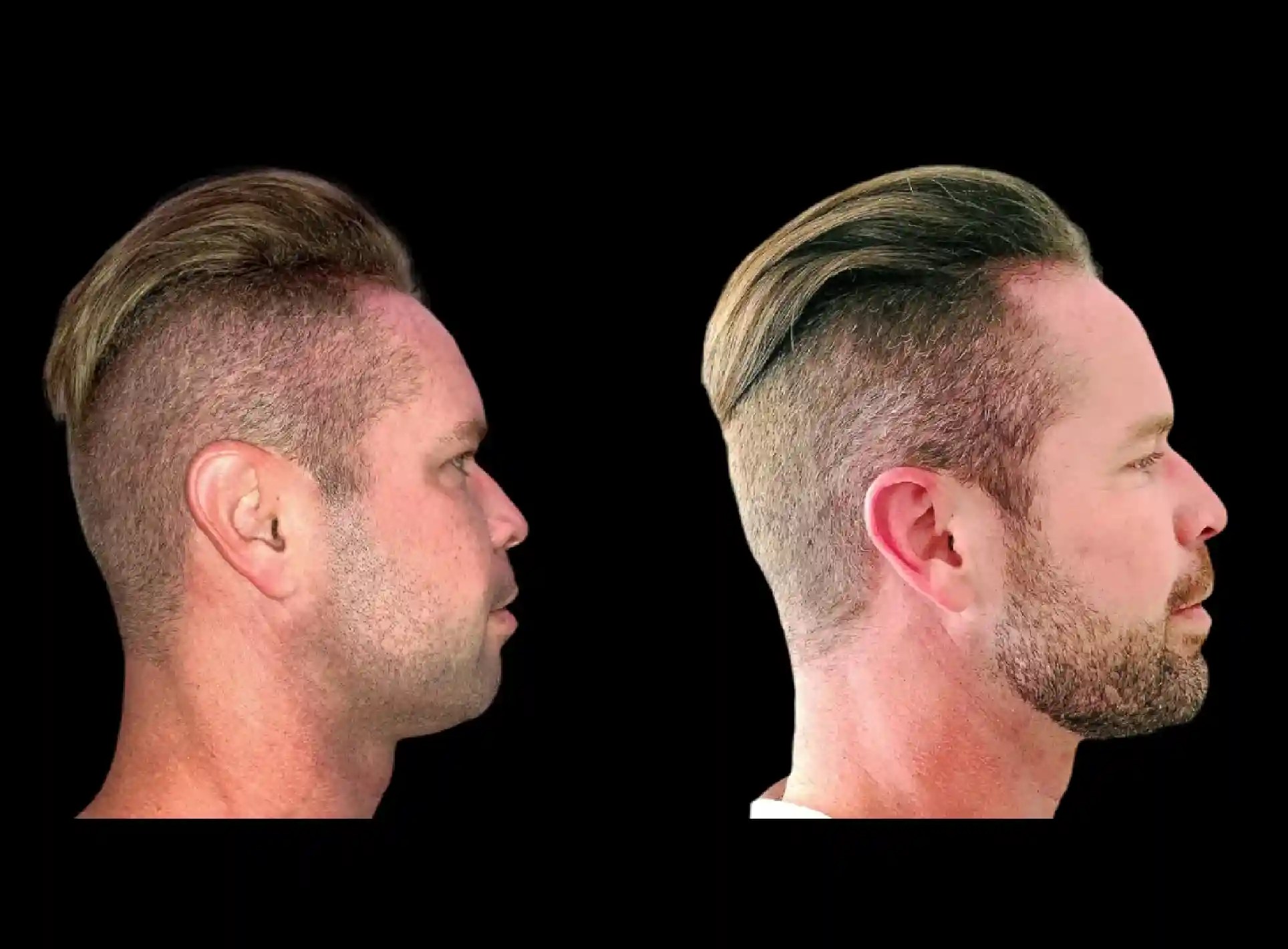 Male chin augmentation in uae