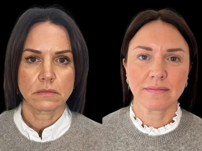 face wrinkle fat transfer in abu dhabi