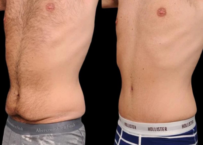 Male Tummy Tuck in Uae