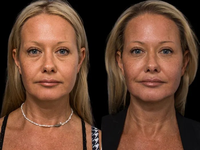 face wrinkle fat transfer in dubai