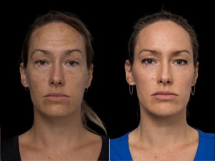 face wrinkle fat transfer picturers in UAE