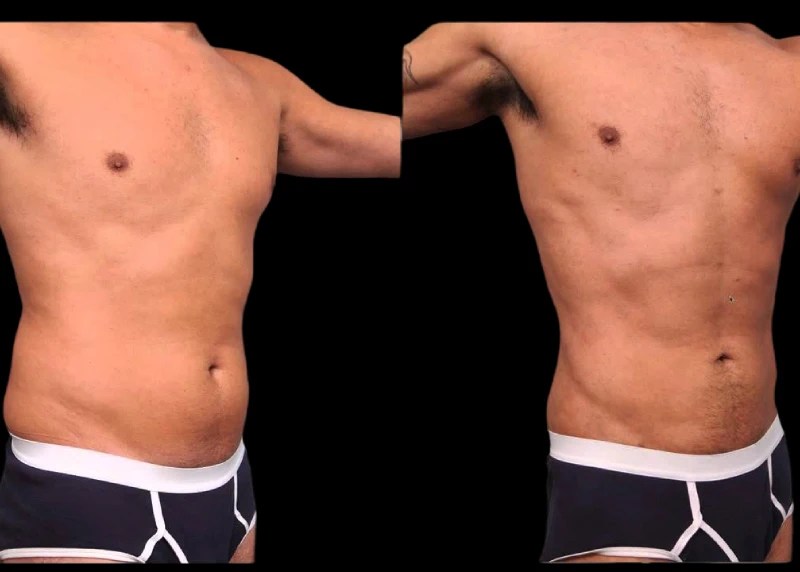 Male Tummy Tuck Images in Abu Dhabi