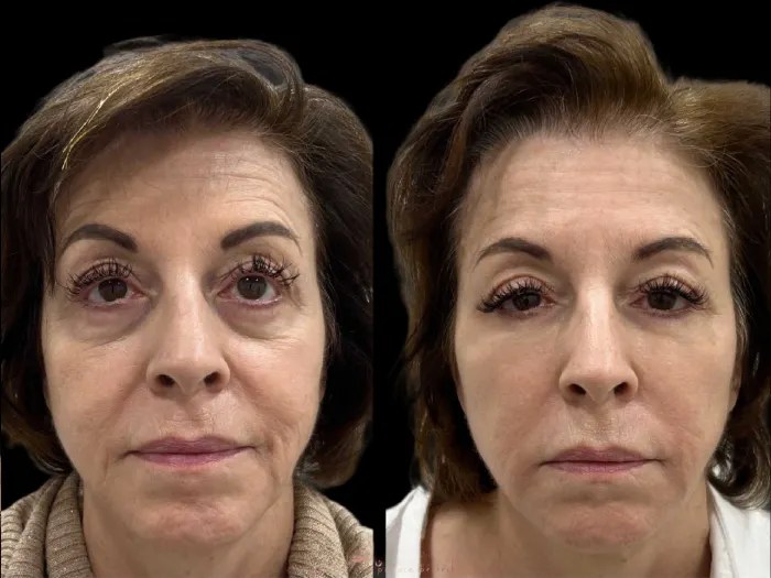 face wrinkle fat transfer images in abu dhabi