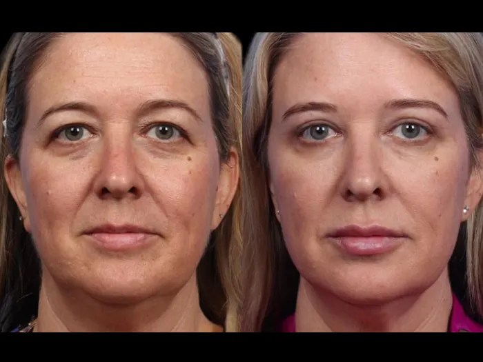 face wrinkle fat transfer images in dubai