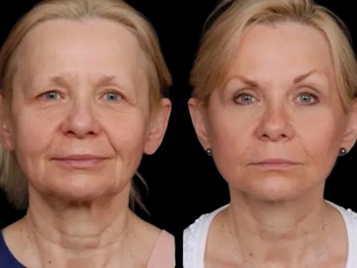 face wrinkle fat transfer images in UAE