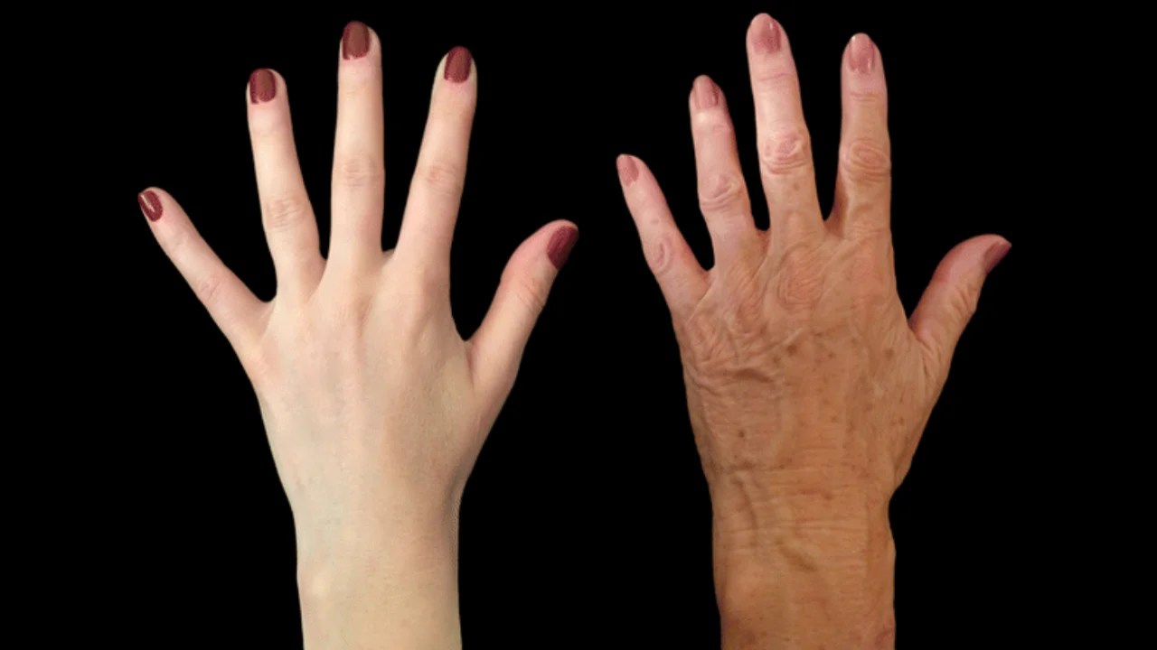 Hands Fat Transfer in Dubai