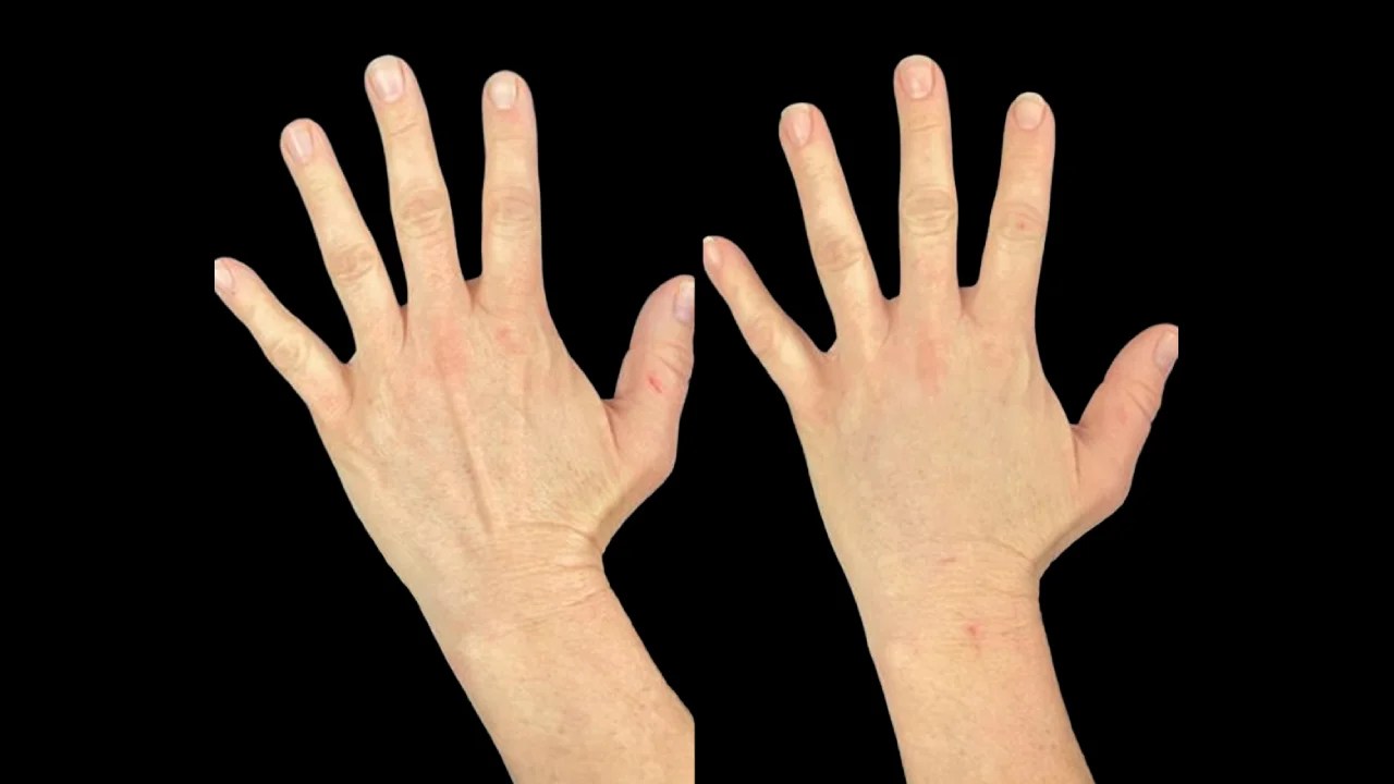 Hands Fat Transfer in Uae