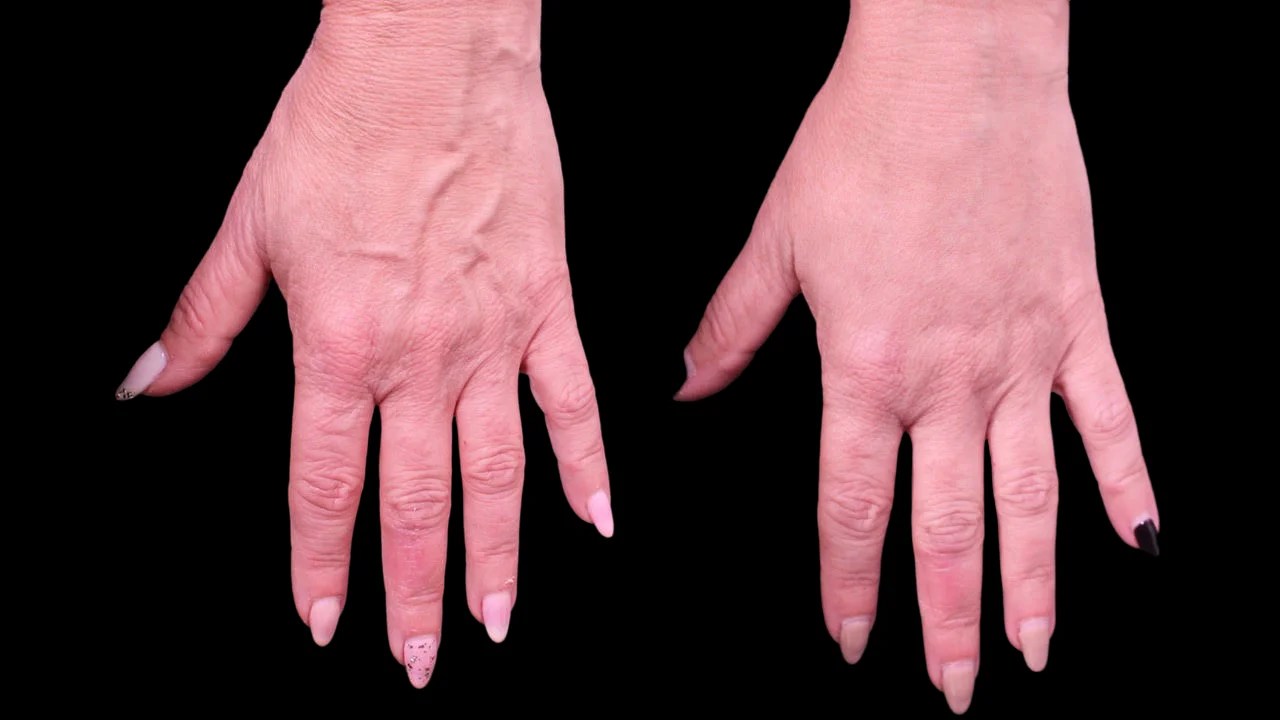 Hands Fat Transfer Before and After in Dubai