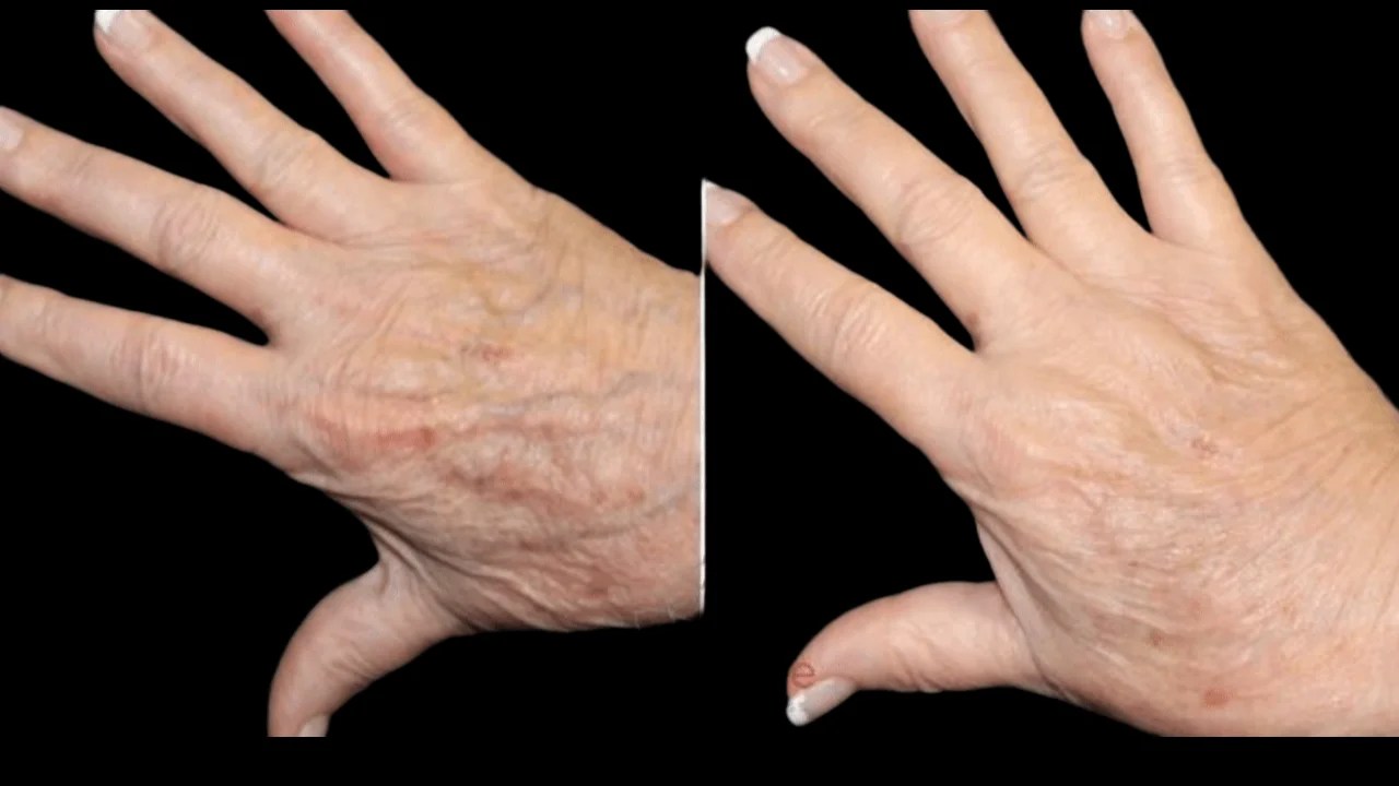 Hands Fat Transfer Before and After in Uae