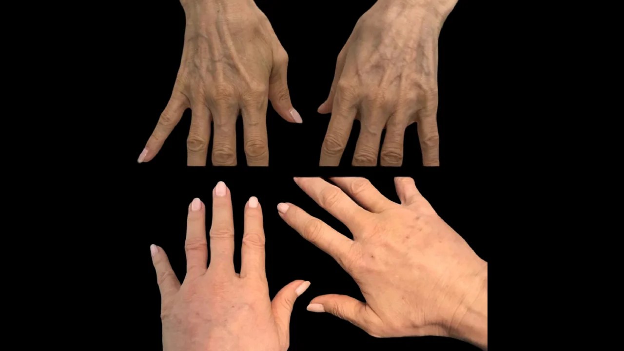 Hands Fat Transfer Before and After Recovery in Dubai