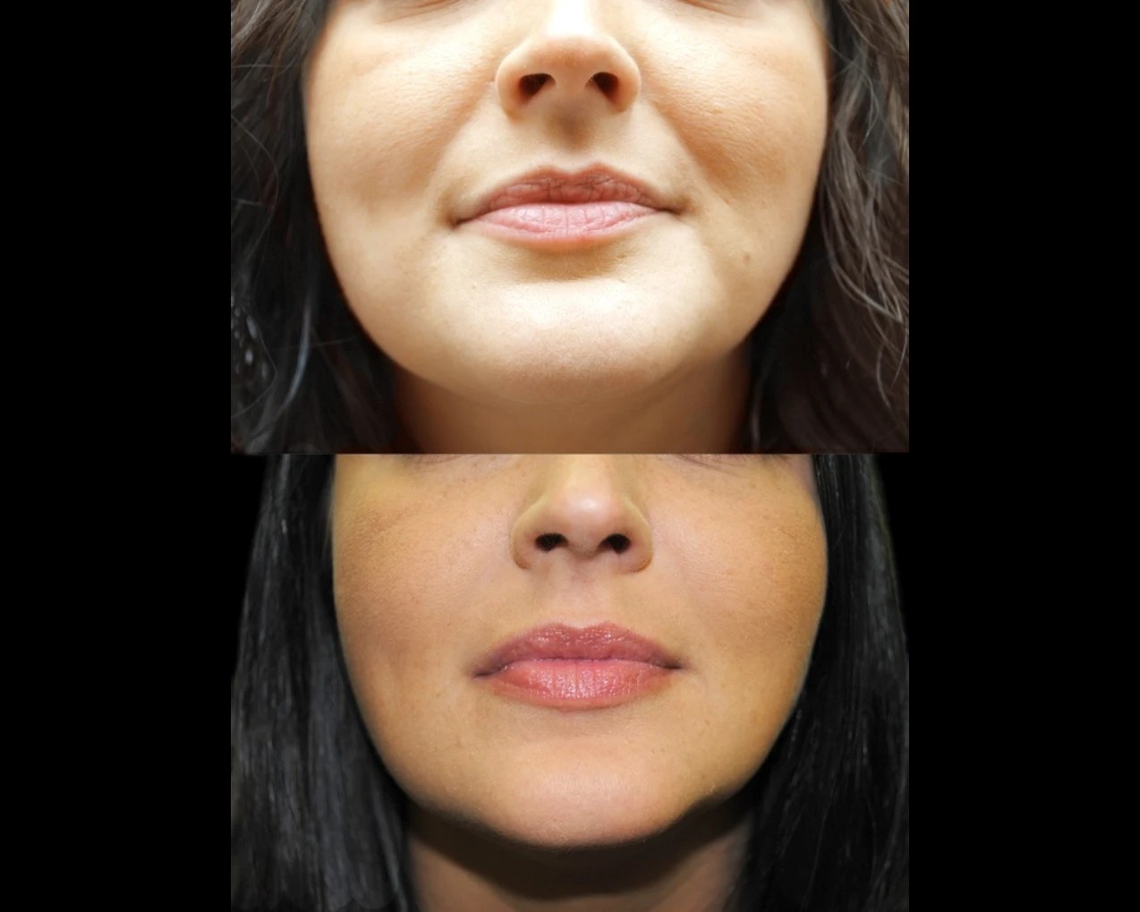 dissolving fillers before and after in dubai