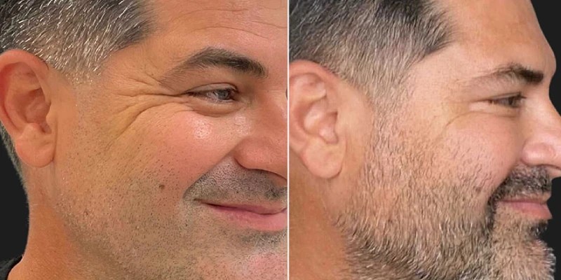 Crow's feet botox