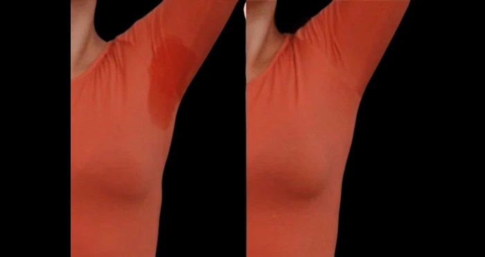 Botox for underarm sweating