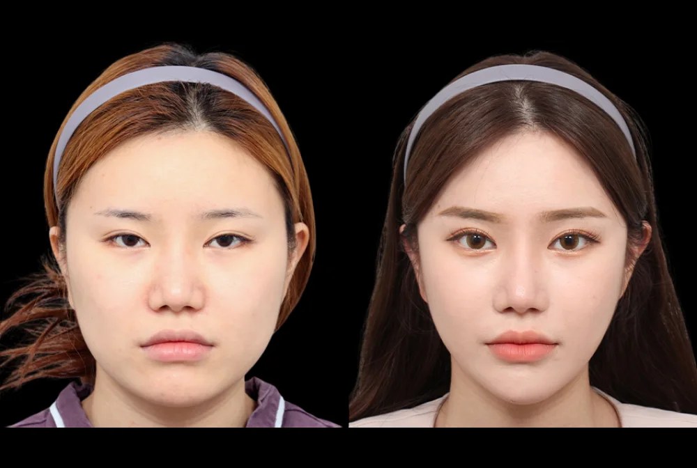 Face contouring in uae