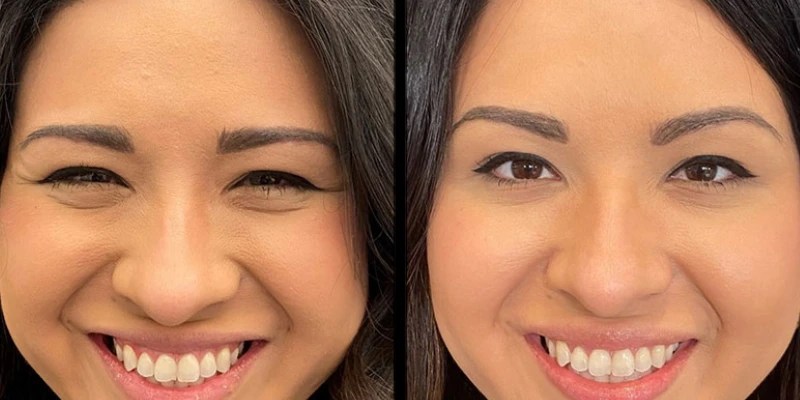 Crow's feet botox