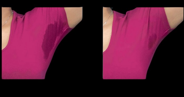 Botox for underarm sweating