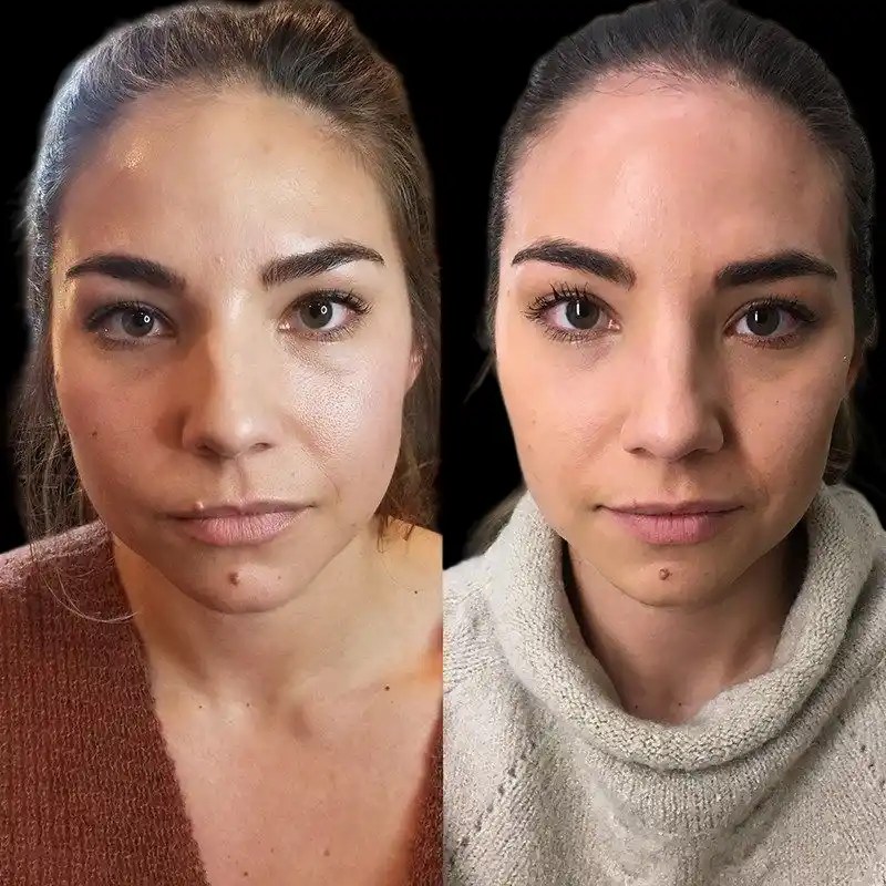 Botox for tmj in dubai