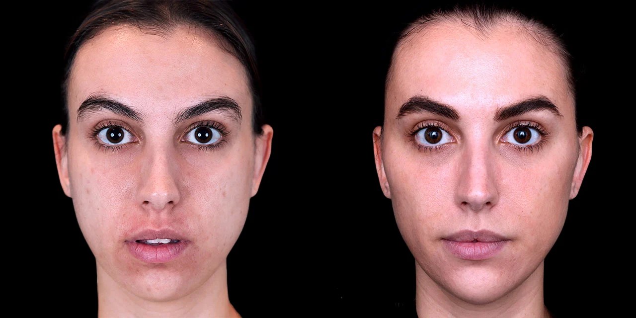 Face contouring before after