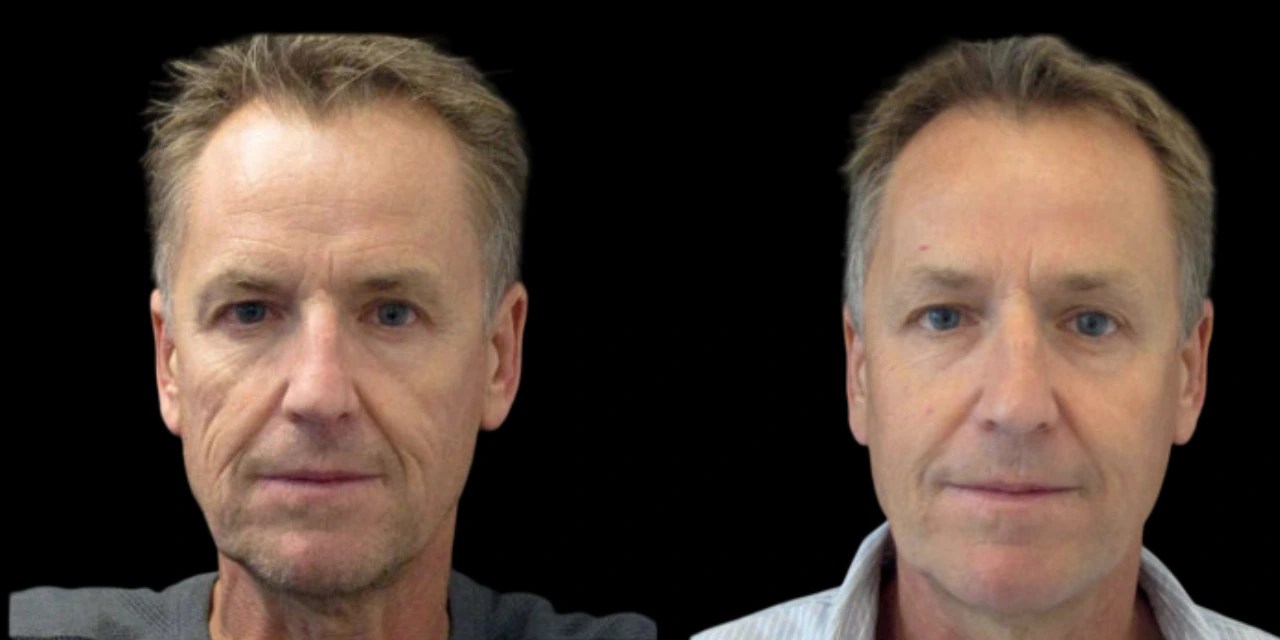 Face contouring before after