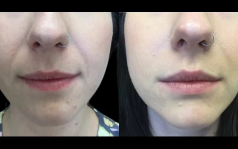 Teosyal fillers