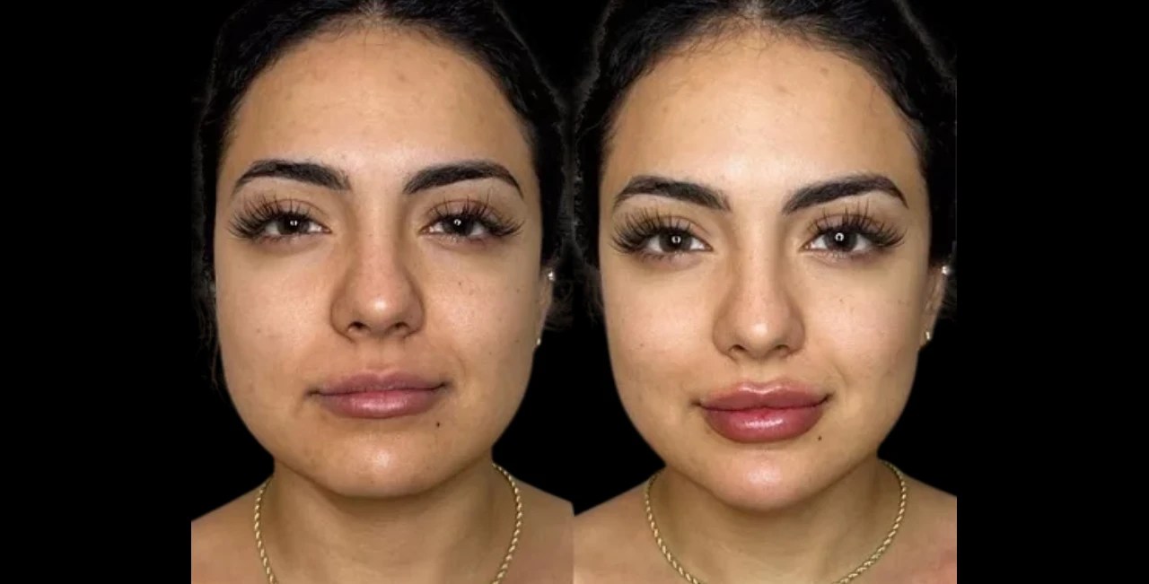 Juvederm Volux In Abu Dhabi