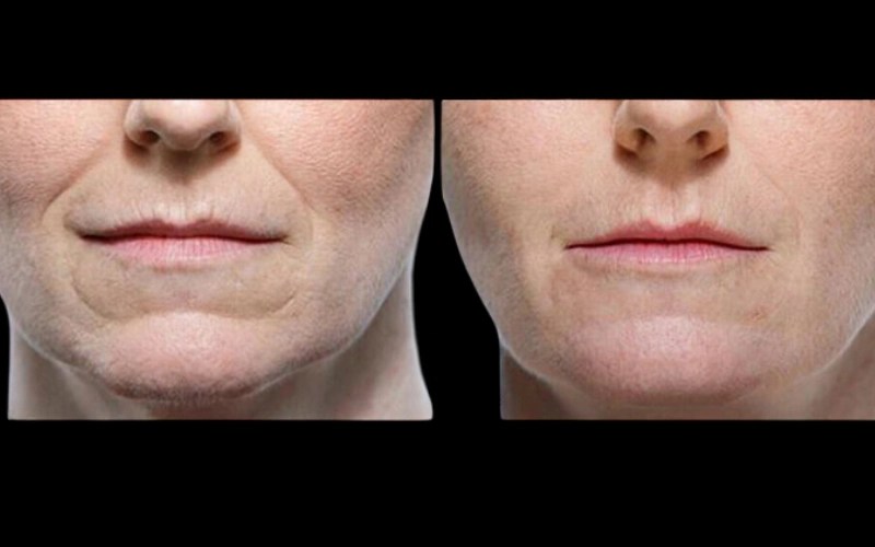Teosyal fillers