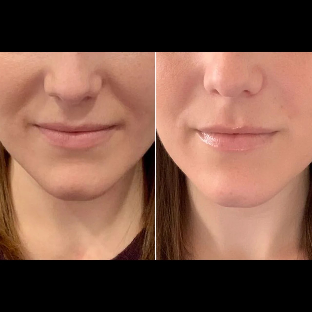 Botox for Nasolabial Fold Before and After in Dubai