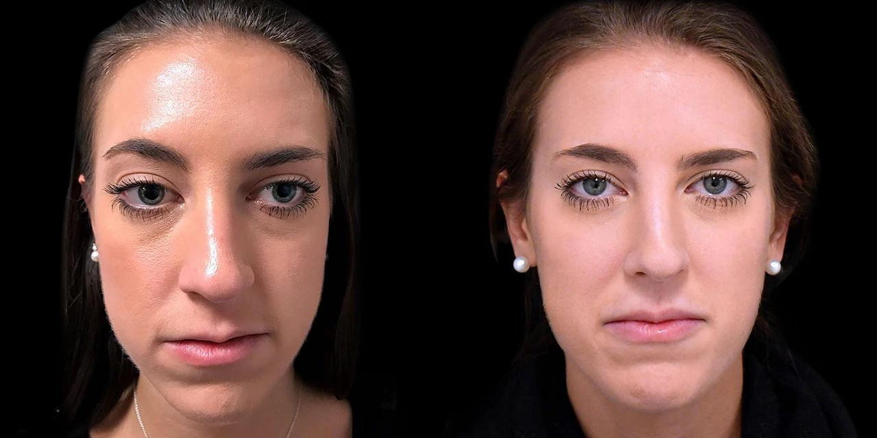 Face contouring before after