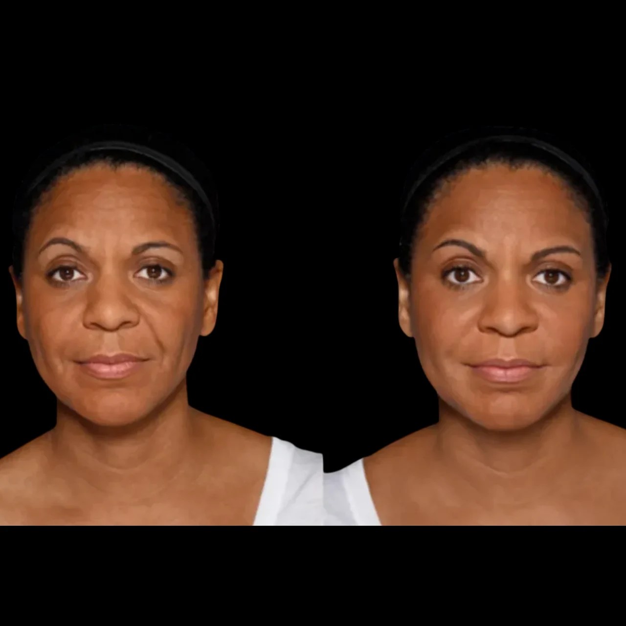 Botox for Nasolabial Fold Recovery in Dubai