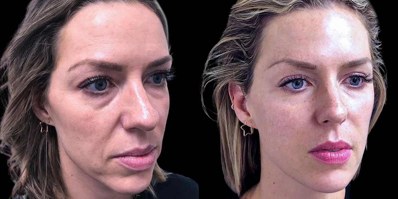 Face contouring before after