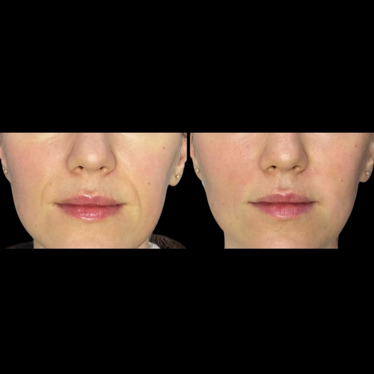 Botox for Nasolabial Fold in Abu Dhabi