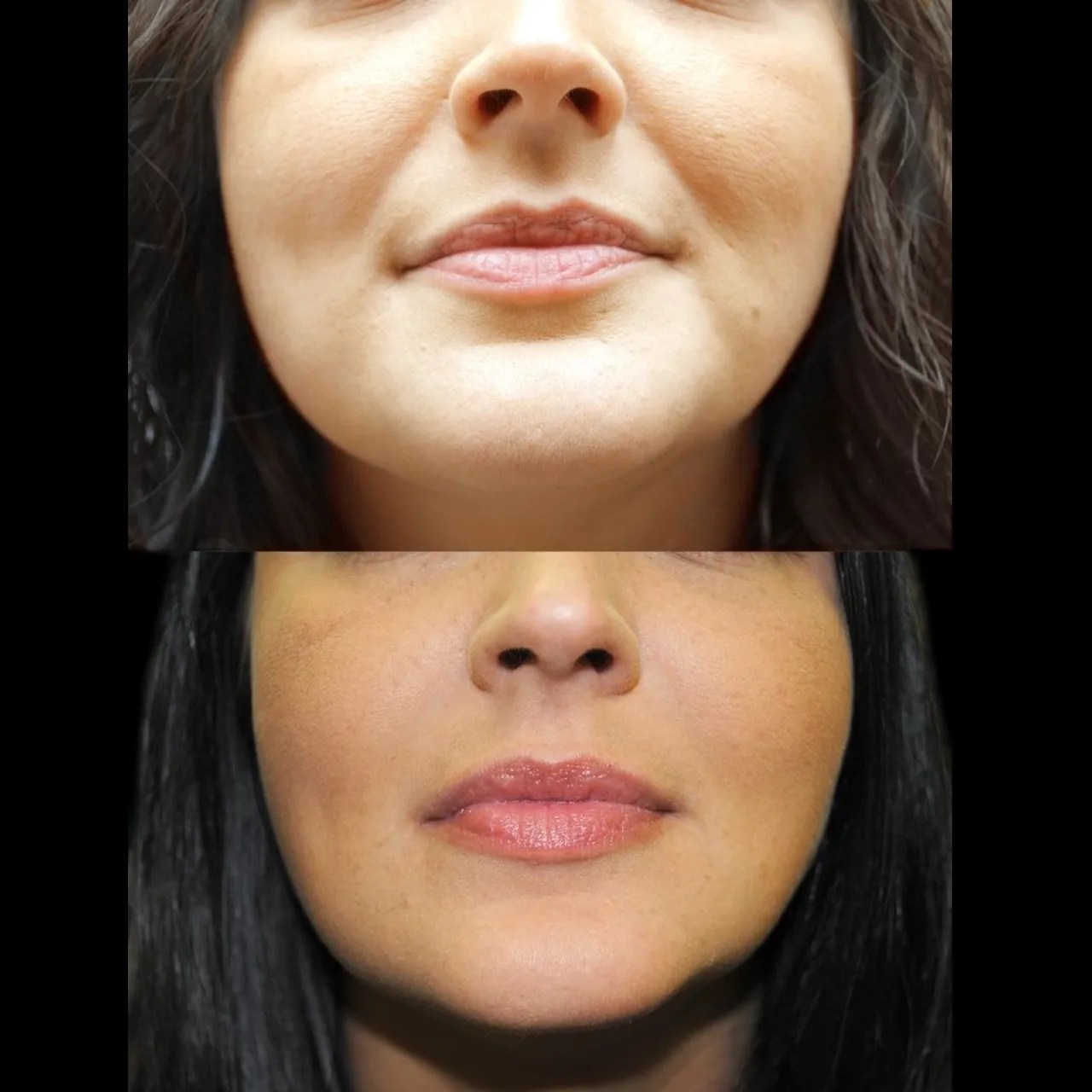 Botox for Nasolabial Fold Recovery in Uae