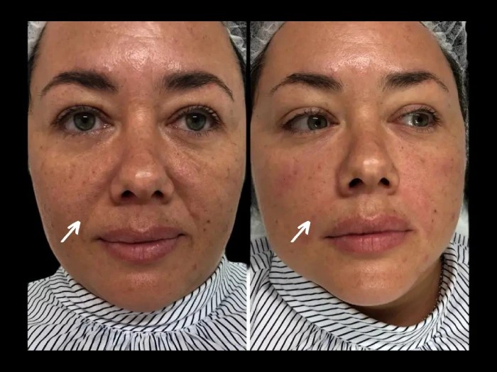Liquid facelift