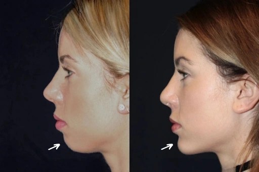 Facial implants before and after in uae