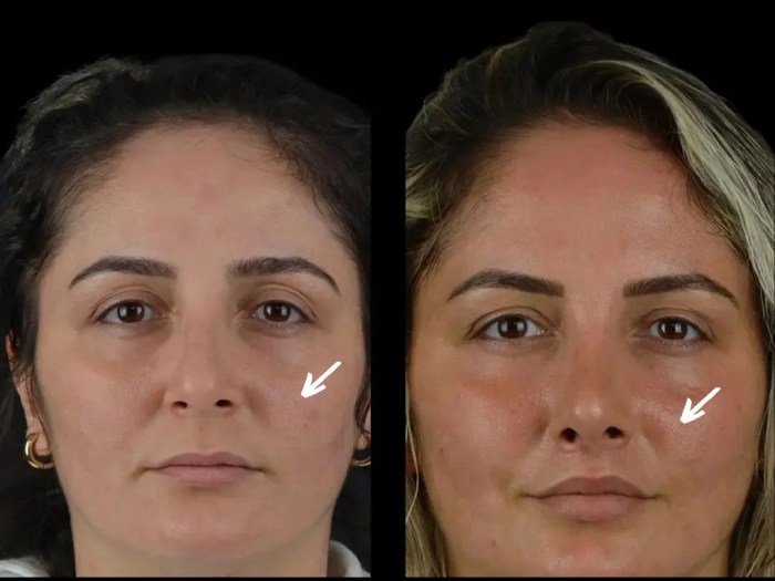 Liquid facelift in abu dhabi