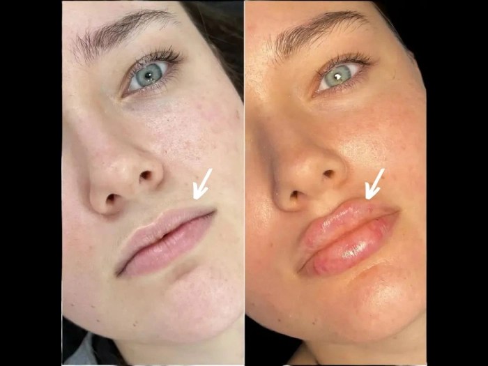 Aliaxin fillers in dubai