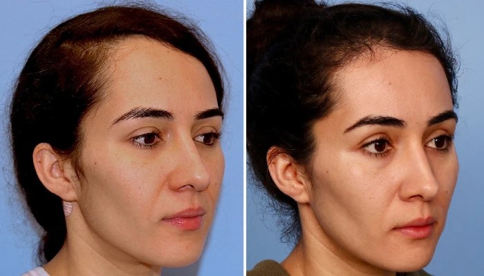 Forehead reduction before after abu dhabi