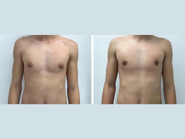 Gynecomastia before and after images in dubai