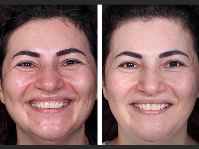 Mesotherapy before after