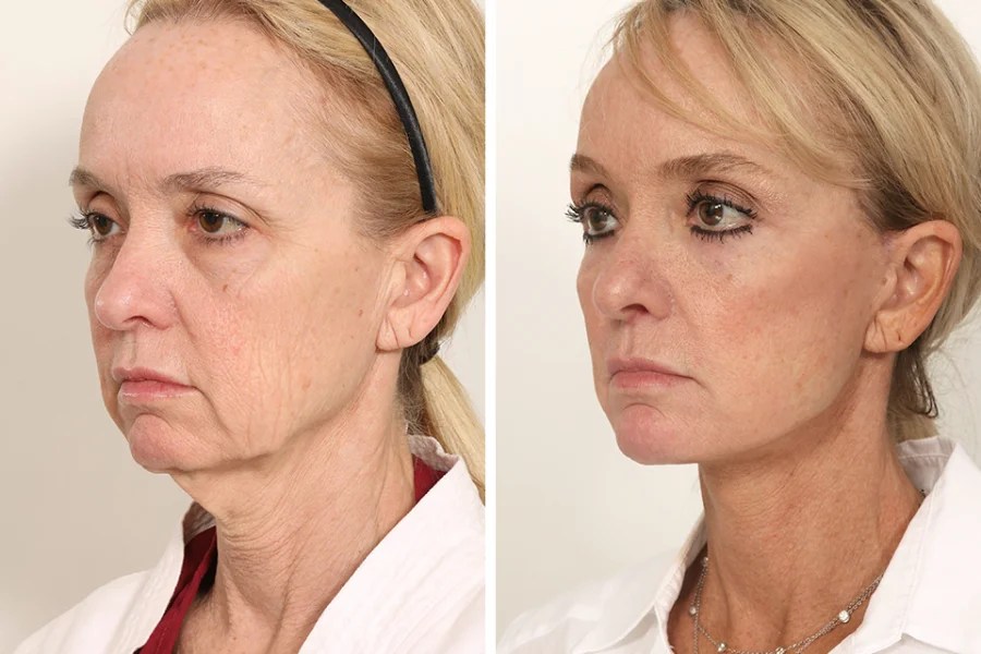 Endoscopic facelift