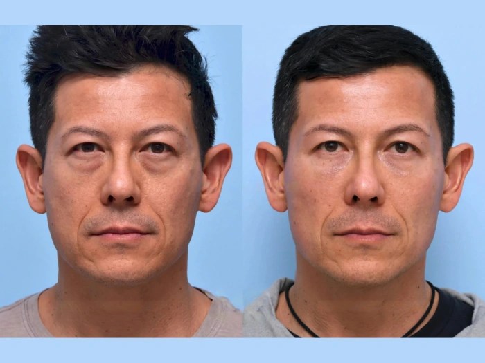 Mesotherapy pictures before after