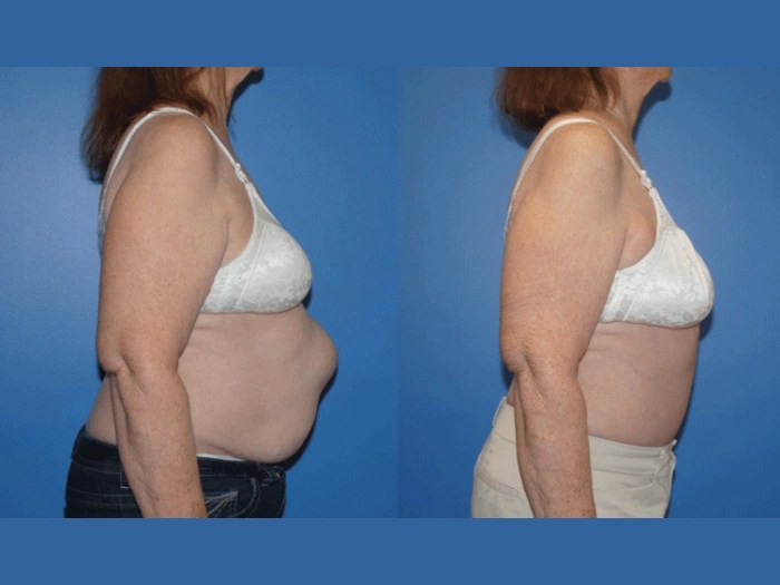 Reconstructive surgery