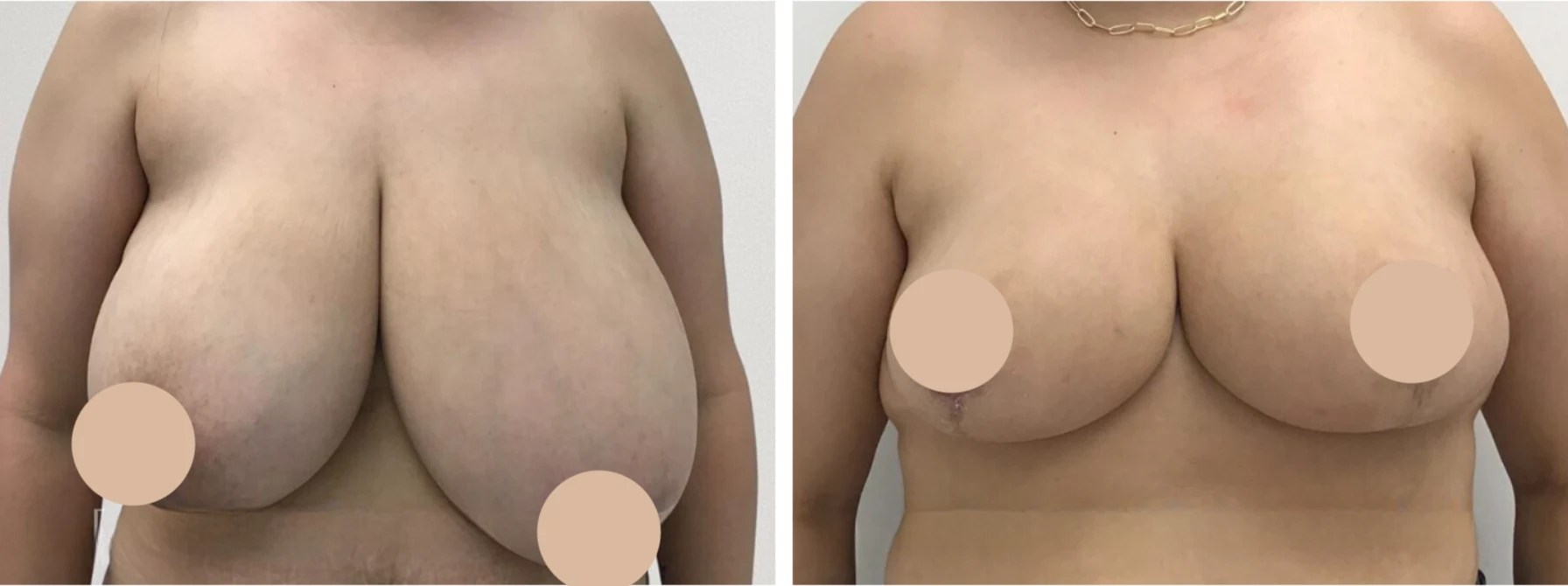 Breast reduction before after for women